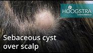 Sebaceous cyst over scalp (21066)