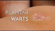 Plantar Warts (Verrucas) - Podiatrist Georgina Tay, East Coast Podiatry