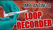 Loop Recorder Implant Procedure