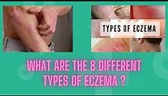 What Are the 8 Different Types of Eczema #eczema