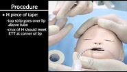 "Securing Oral and Nasal Endotracheal Tubes" by Craig Smallwood, RRT, for OPENPediatrics