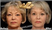Collagen stimulation / Even if you are 70 years old, apply it to wrinkles, and they will disappear