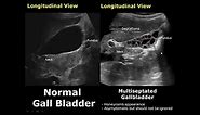 Gallbladder Ultrasound Normal Vs Abnormal Image Appearances Comparison | Gallbladder Pathologies USG