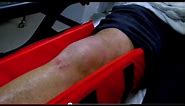 Shattered Knee (Part 1) - Bizarre ER