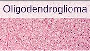 Oligodendroglioma - Pathology mini tutorial
