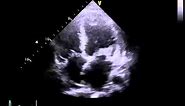 Echocardiography to Assess Mitral-Valve Leaflets | NEJM