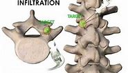 ULTRASOUND GUIDED FACET JOINT AND MEDIAL BRANCH INFILTRATION