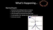 Bundle Branch Block ( ECG / EKG )