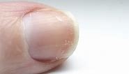 What the white marks on your fingernails mean