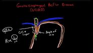 Pathophysiology of Gastroesophageal Reflux Disease (GERD)