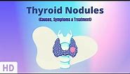 Thyroid Nodules: Causes, Symptoms and Treatment