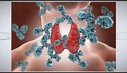 Understanding Autoimmune Thyroid Disease