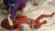 World’s Smallest Surviving Baby Going Home After 5 Months at Sharp Mary Birch Hospital