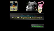 Ultrasound Case 181 - Pregnant with Dermoid Cyst