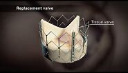 TAVI (Transcatheter Aortic Valve Implantation)