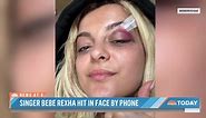 Bebe Rexha posts new video of injuries after being hit by phone