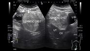 Ultrasound Video showing a simple ovarian cyst and a Dermoid ovarian cyst.