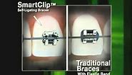 Smart Clip Self ligating braces