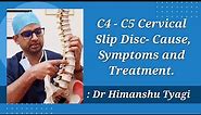 C4 - C5 Cervical Slip Disc- Cause, Symptoms and Treatment.