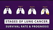 Stages of Lung Cancer. Survival rate & Prognosis. | Episode 5