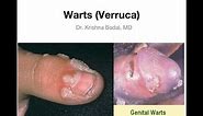 Warts (Verruca)