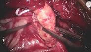 Carotid Endarterectomy: Basic Techniques