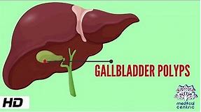 Gallbladder Polyp, Causes, Signs and Symptoms, Diagnosis and Treatment.