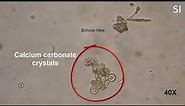 Calcium carbonate crystals in urine !!!