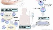 T-cell Transfer Therapy - Immunotherapy