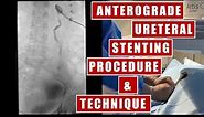Trans-nephrostomy Ureteral Stent placement under fluoroscopy guidance: procedure and technique