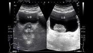 Ultrasound Video showing a Tumor in Urinary Bladder.