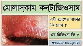 Molluscum contagiosum symptoms, signs, and treatment of this eyelid condition.