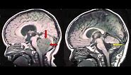 Brain Tumor Overview