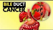 BIle Duct Cancer (Cholangiocarcinoma), Causes, Signs and Symptoms, Diagnosis and Treatment.