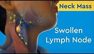 Neck Mass: Swollen Lymph Node