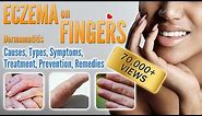 Eczema on Fingers Causes, Types, Symptoms, Treatment and Remedies | Small Blisters and How To Treat
