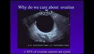 Screening of Ovarian Cancer