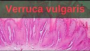 Verruca Vulgaris - Pathology mini tutorial
