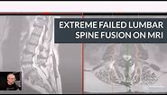 Extreme Failed Lumbar Fusion on MRI