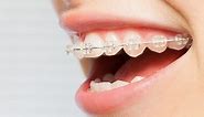 Clear Braces Cost, Types, Reviews: Complete Guide - Dentaly.org