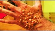 Trypophobia Hand - What is it?