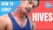 How to treat Hives (Urticaria)? - Doctor Explains