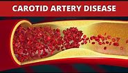 Treatment of Carotid Artery Disease