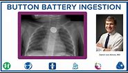 Button Battery Ingestion