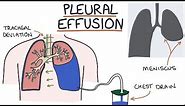 Understanding Pleural Effusions