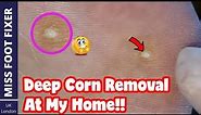 My Way of Working At Home *** Deep Corn Removal At home *** Full treatment by Miss Foot Fixer