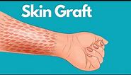 Skin Graft Healing And After Care