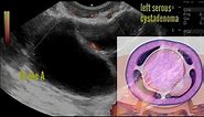 Serous vs mucinous cystadenoma left ovary. Left ovarian septate cyst ultrasound and color Doppler