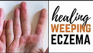 5 Natural Ways to Treat Weeping Eczema