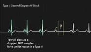 Second Degree Heart Blocks - Type I vs Type II